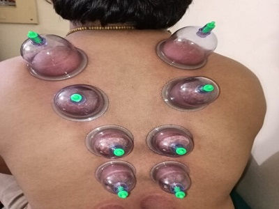 Cupping Therapy